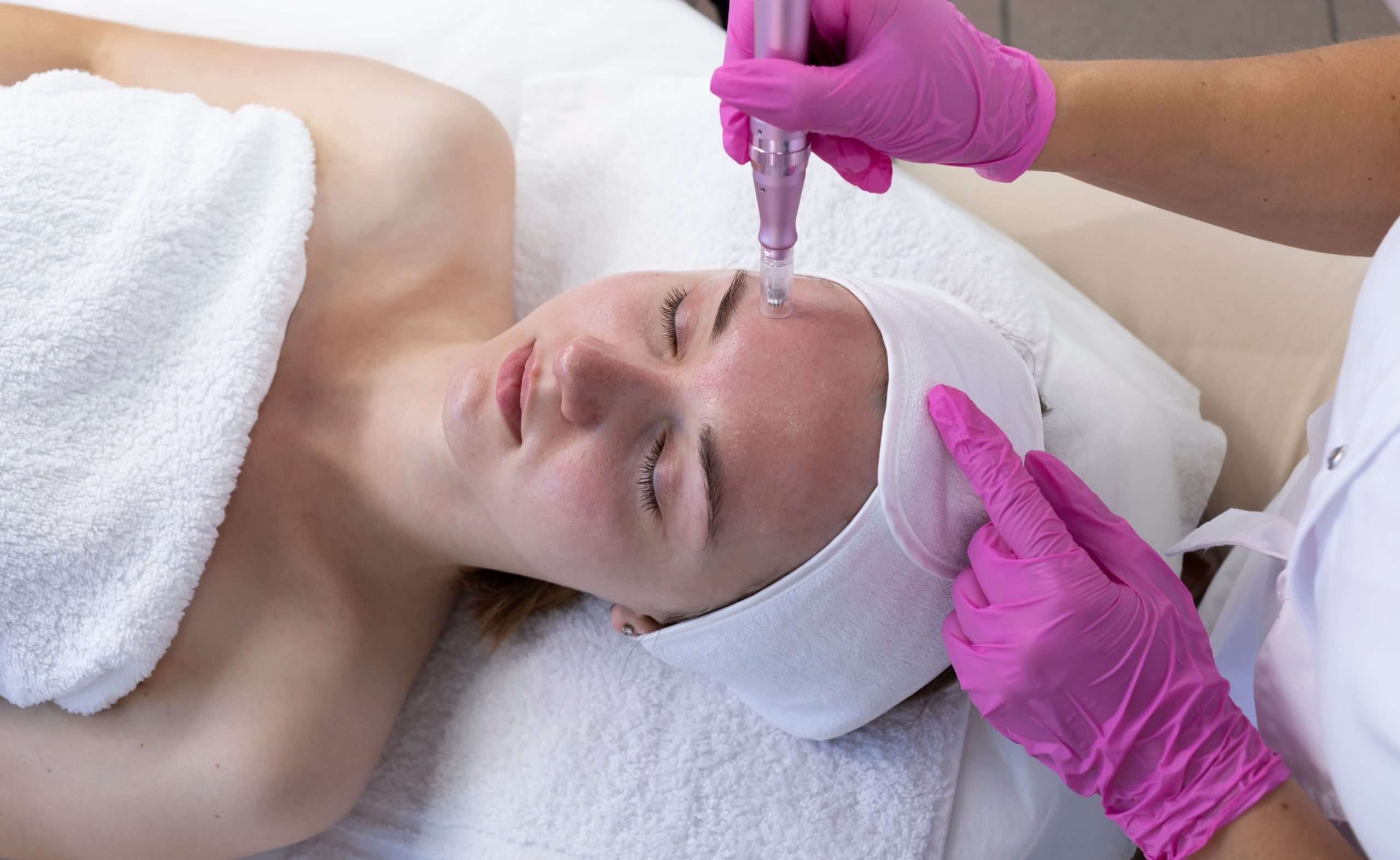 Microneedling Treatment by Beauty Boss Co. Aesthetics & Wellness in Cabot AR